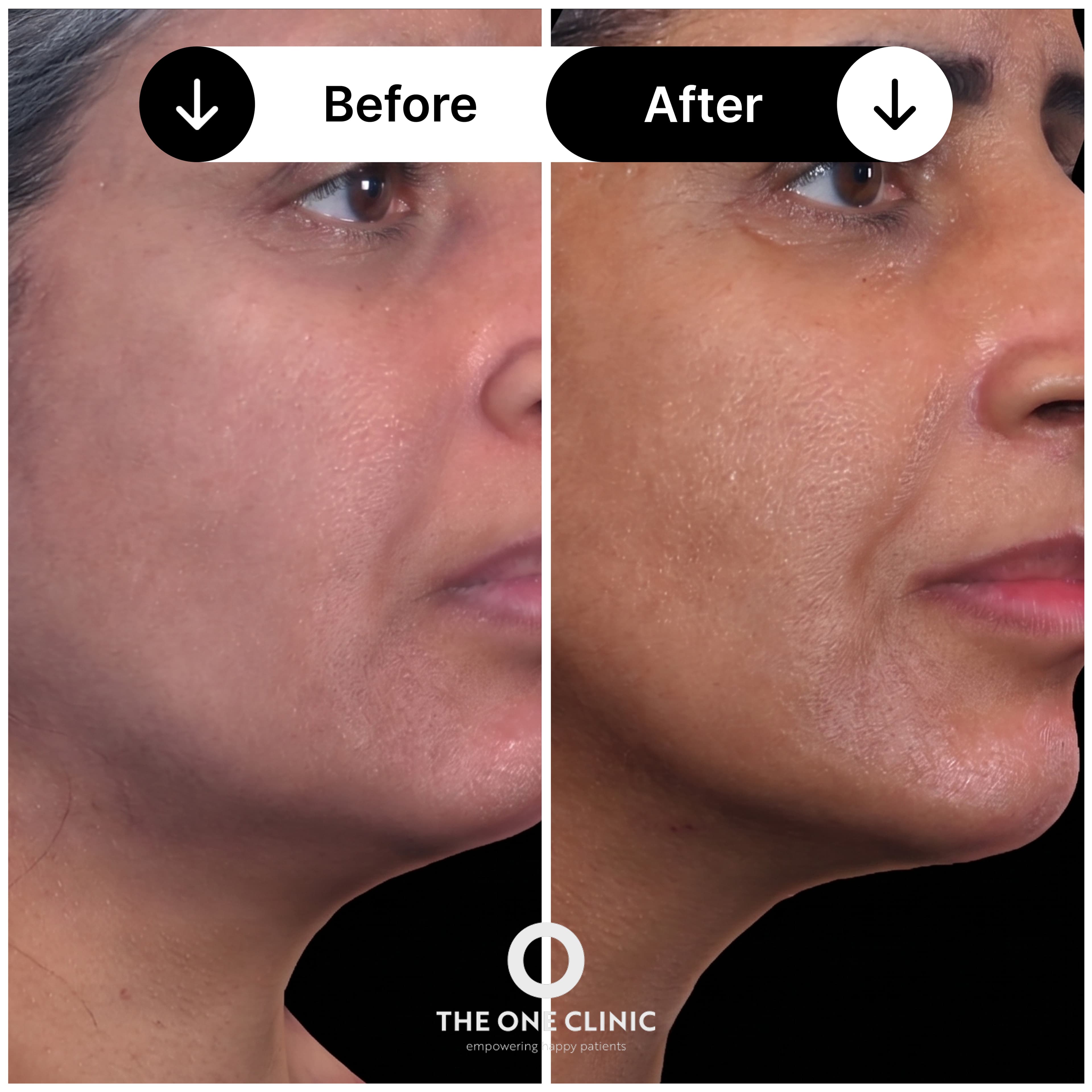 Morpheus8 before and after result 2