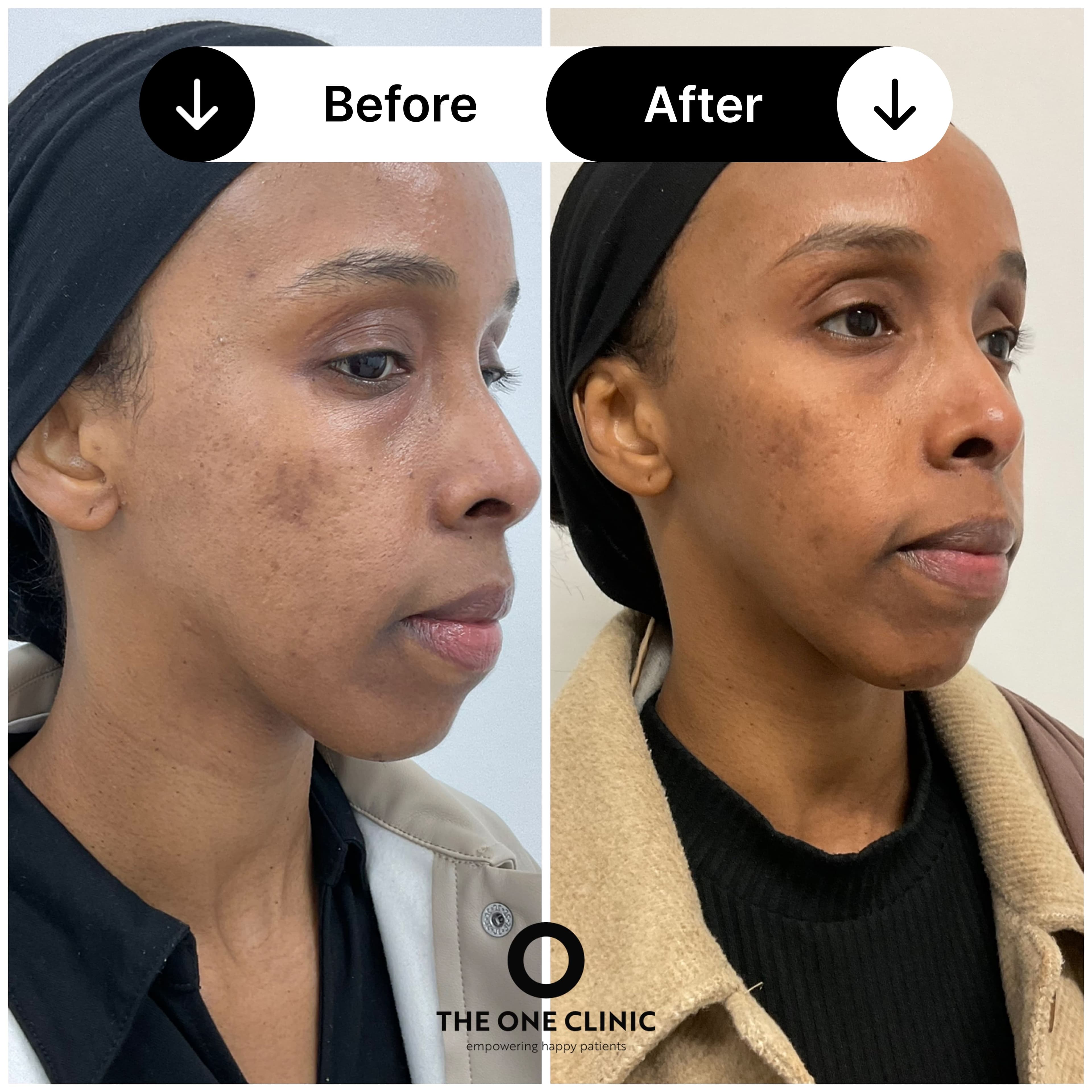Morpheus 8 before and after result