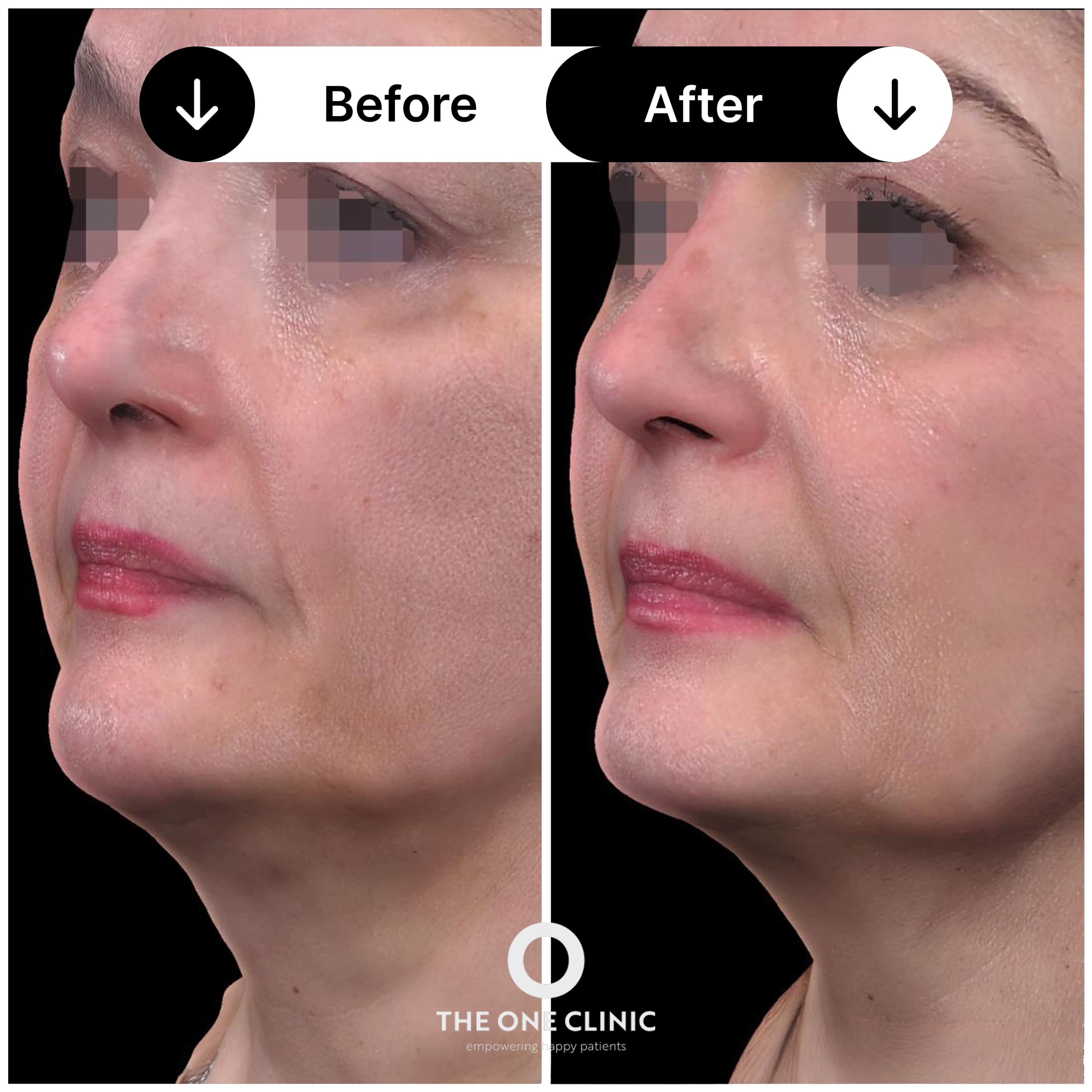 Morpheus 8 before and after result