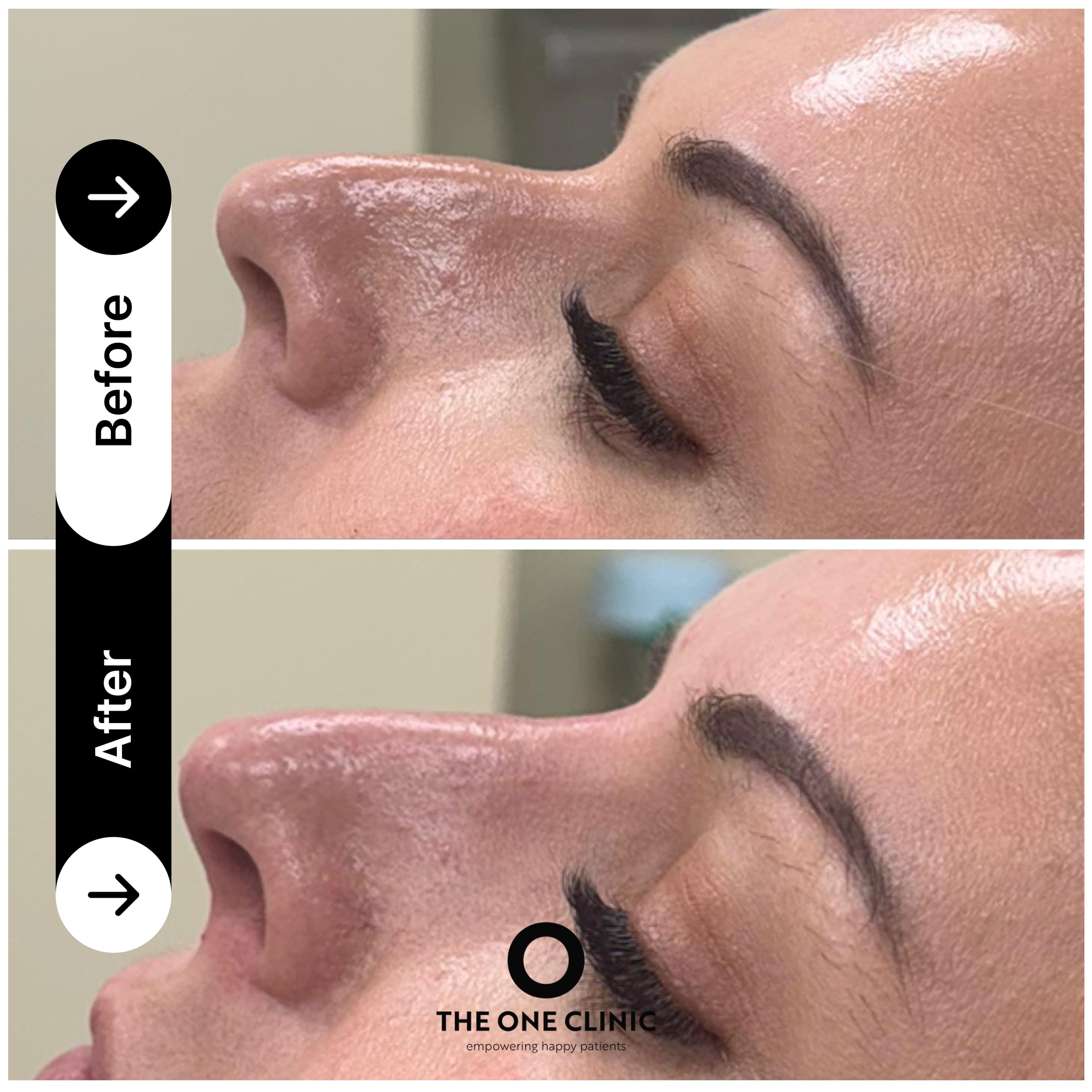 Non-surgical rhinoplasty before and after results