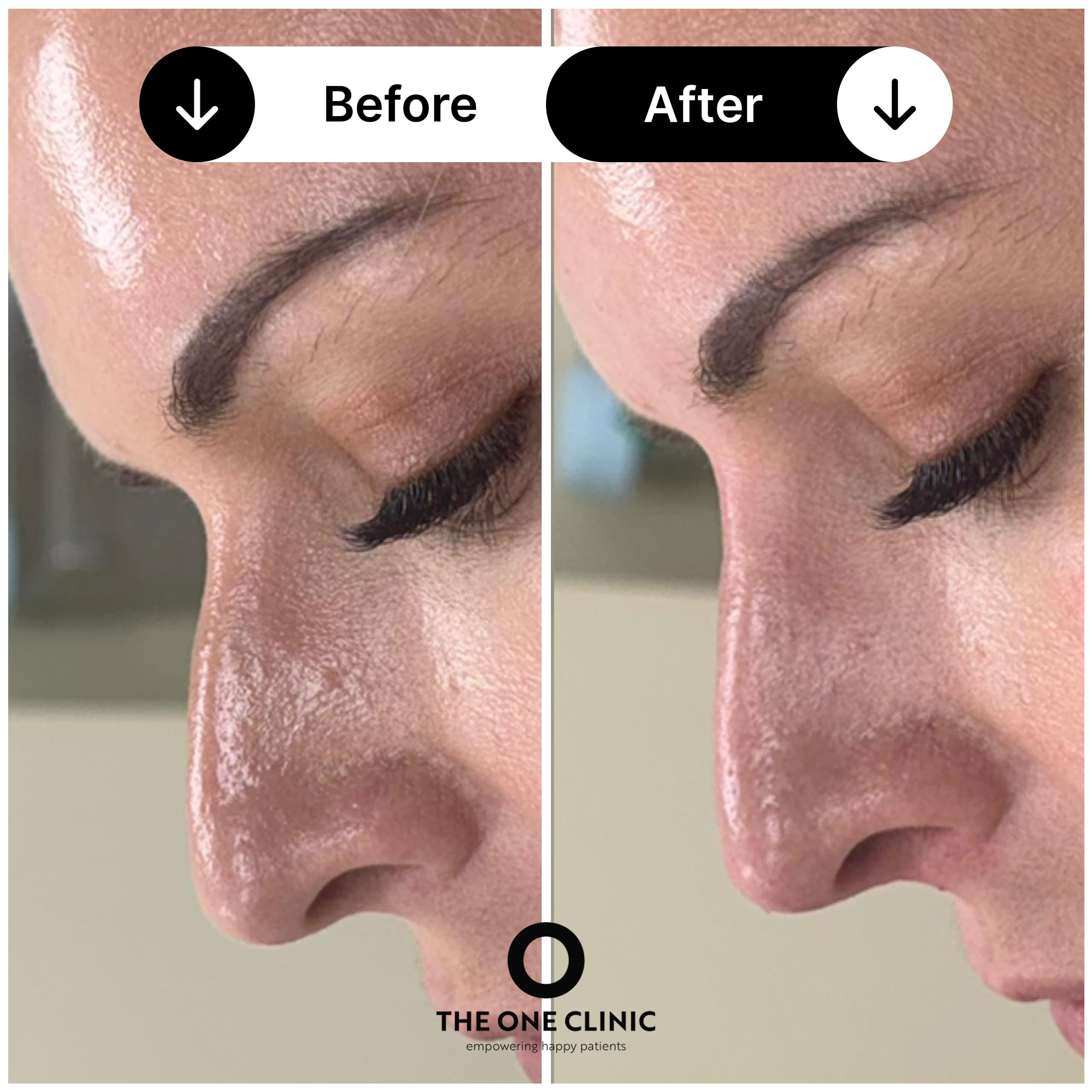 Non-surgical rhinoplasty before and after results