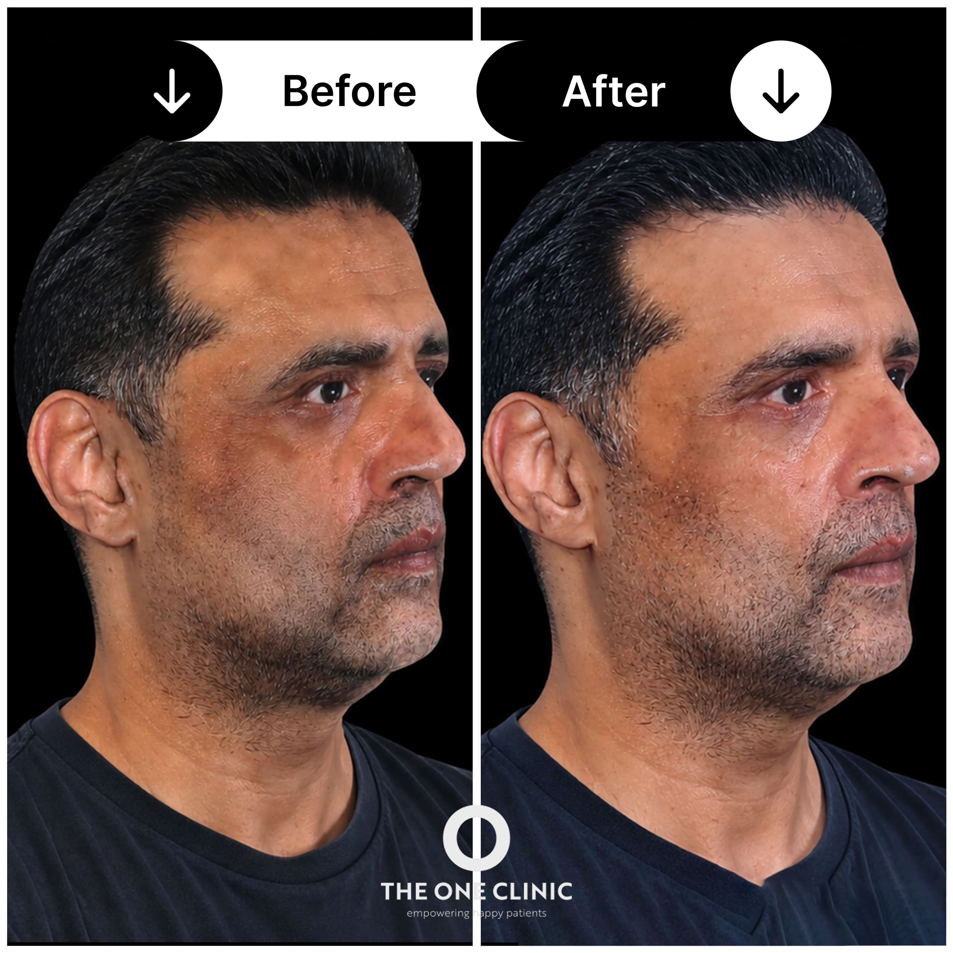 Pigmentation treatment before and after