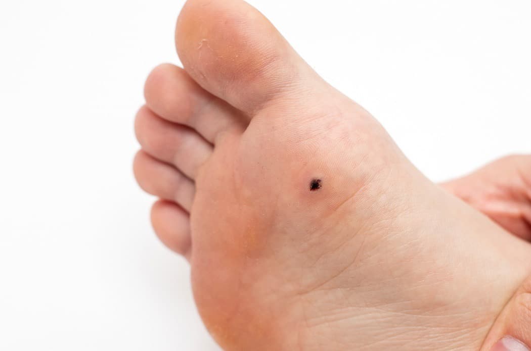 Verruca Healing Stages: What to Expect
