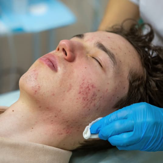 Acne scar removal consultation at The One Clinic