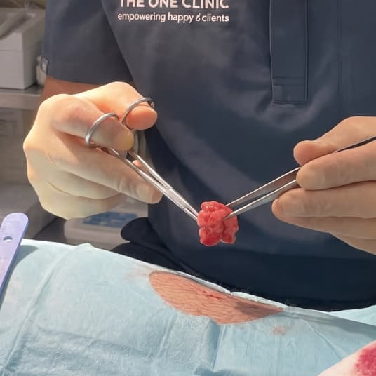 Lipoma removal consultation at The One Clinic Leicester