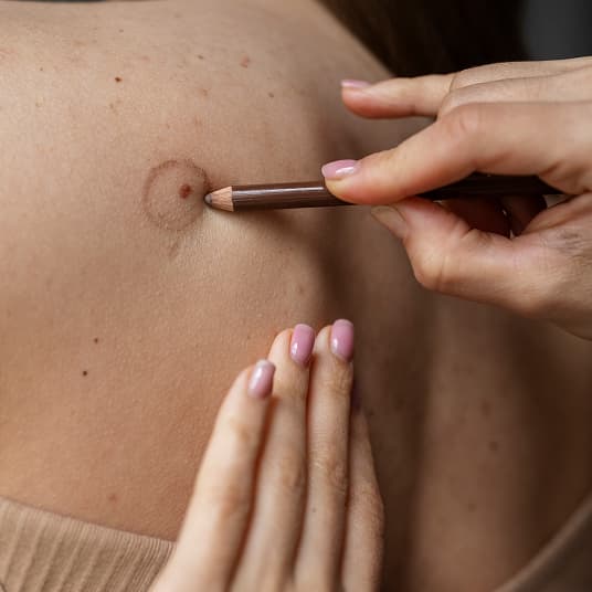 Mole removal consultation at The One Clinic