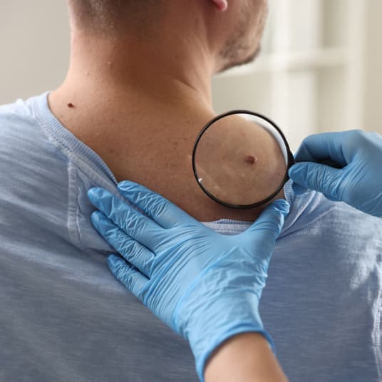 Doctor reviewing skin tag at The One Clinic Leicester