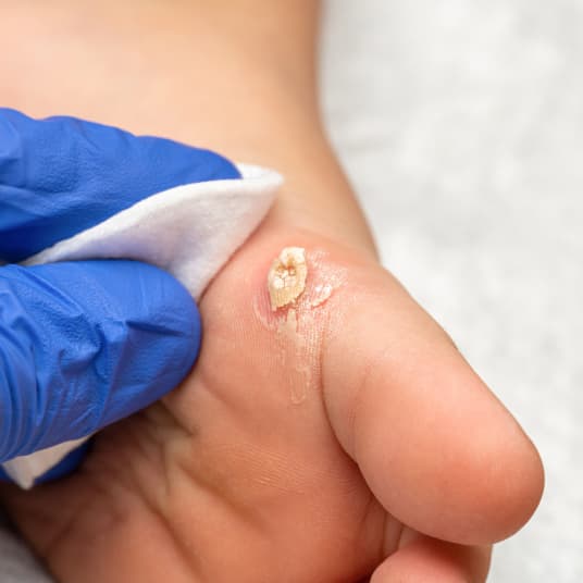 Doctor consultation for wart removal at The One Clinic
